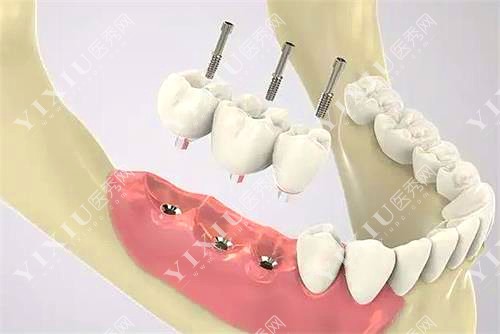延吉韩世口腔医院贵吗？公布全新延吉韩世口腔医院价格表(图6)