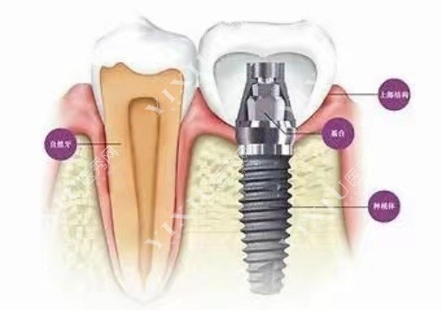 徐州种植牙构造图