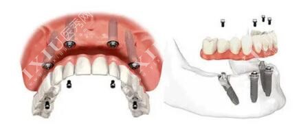 半口种植牙修复改善