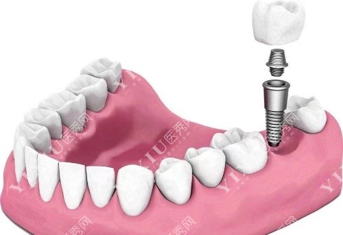 徐州正博口腔医院种植牙过程图
