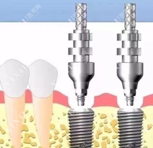 无锡种植牙过程图