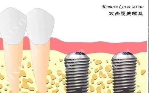 取出覆盖螺丝