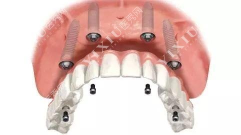 全口种植牙示意图