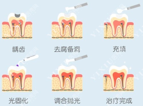 补牙过程示意图