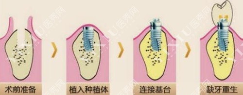 种植牙过程示意图