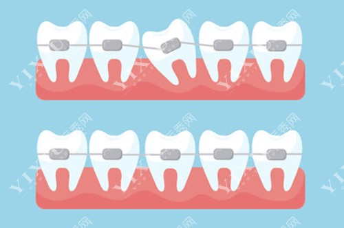 牙齿矫正卡通示意图