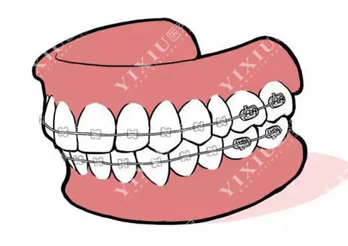 牙齿矫正卡通示意图
