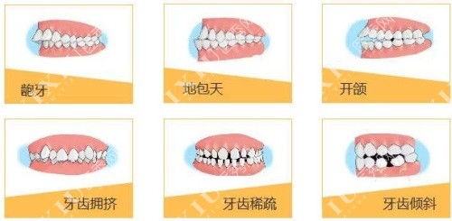 各类畸形牙齿示意图