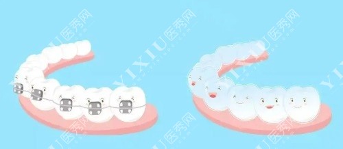 牙齿矫正示意图