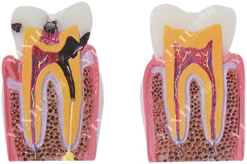 牙齿龋坏到牙髓对比模型示意图