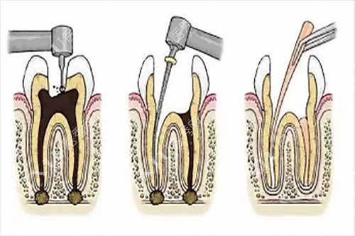 牙齿根管治疗简单过程示意图