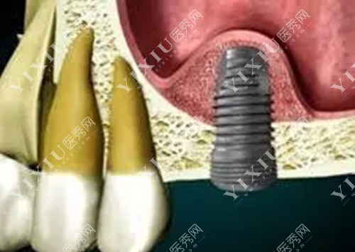 上颌后牙种植体安装示意图
