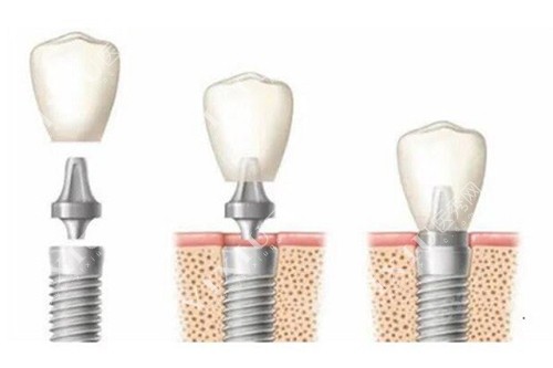 种植牙简单过程示意图
