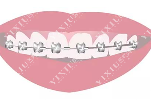 唇侧牙齿矫正卡通示意图