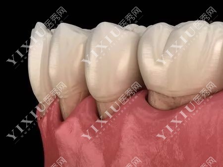 牙结石掉了是好事坏事?简述牙结石的形成危害及处理方式(图6) 牙结石掉了是好事坏事?简述牙结石的形成危害及处理方式(图6)