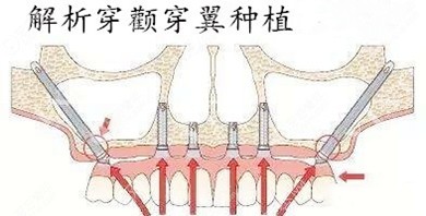 海南华美口腔种植一颗牙多少钱？预算3000元来华美种牙真实惠(图4)