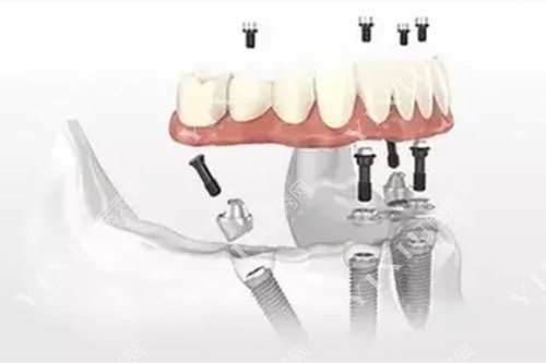 海南华美口腔种植一颗牙多少钱？预算3000元来华美种牙真实惠(图5)