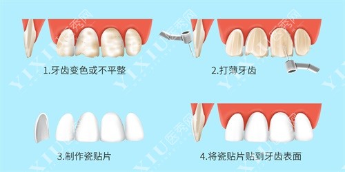 牙齿贴面过程