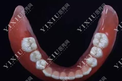 半口活动义齿示意图