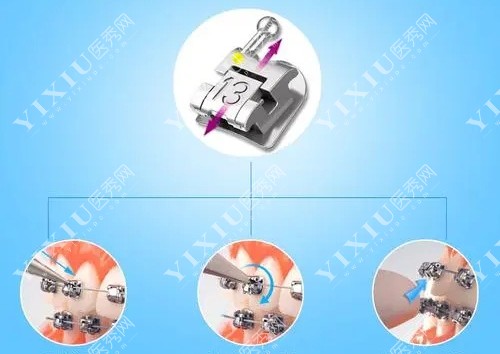 自锁托槽矫正器示意图