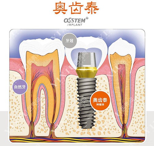 韩国奥齿泰种植牙示意图