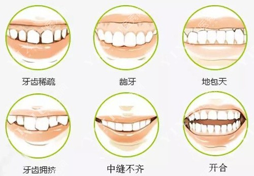 牙体错颌类型展示图