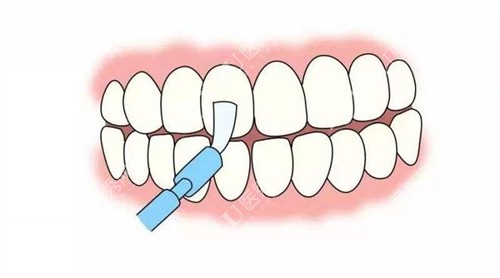 卡通牙齿涂氟图