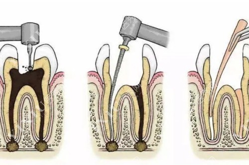 根管治疗步骤展示图