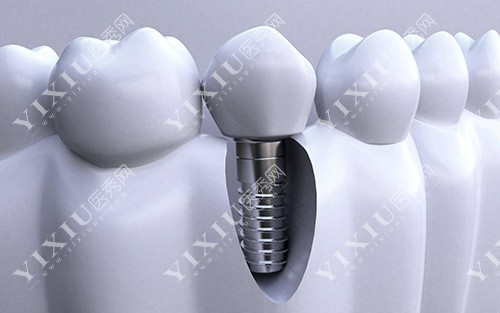 韩国种植牙的品牌前五分享，附送2023年新价格表！(图1)