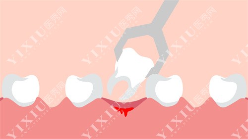 拔牙过程卡通图