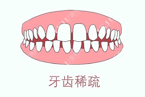 牙齿稀疏卡通图