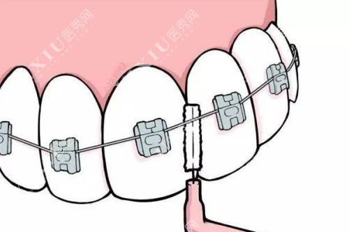 牙齿矫正卡通图