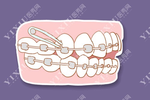 牙齿正畸图