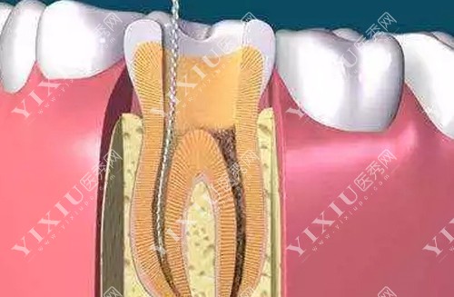 根管治疗内部图