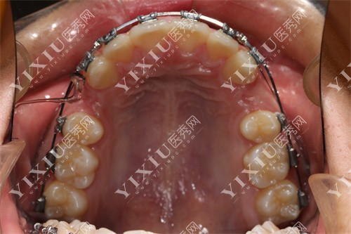 牙齿矫正内部图