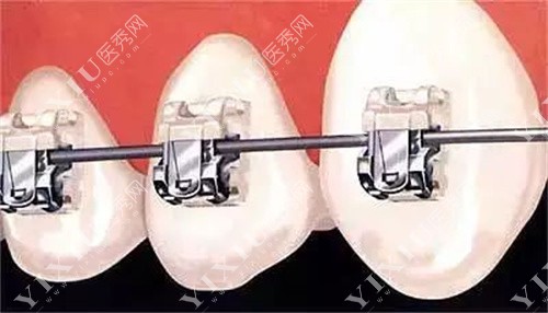 矫正牙齿部分图