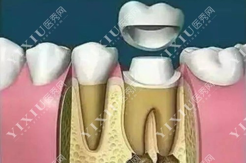 根管治疗牙冠展示图