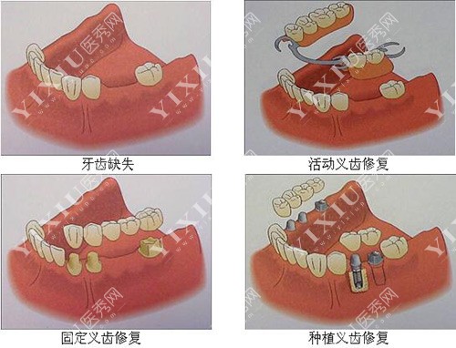 牙齿缺失修复方式示意图