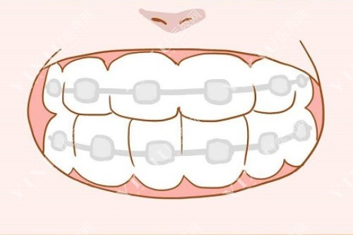牙齿矫正成果图