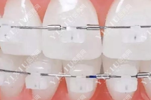 陶瓷矫正器展示图