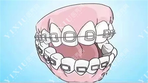 牙齿矫正卡通图