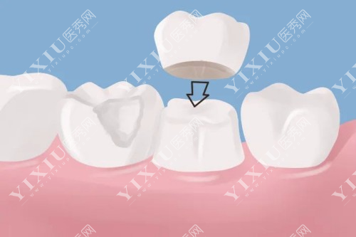 牙冠治疗方法展示图