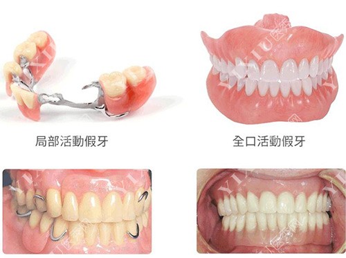 活动假牙固定假牙示意图
