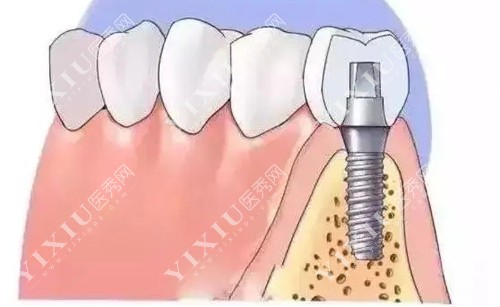 种植牙切面图