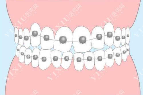 牙齿矫正展示图