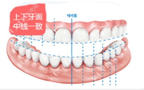 牙线美学设计图