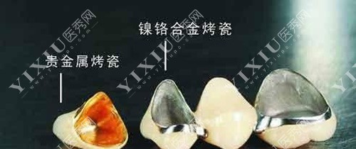 镶牙烤瓷牙材料示意图