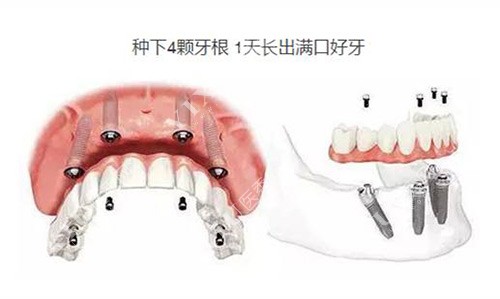 全口即刻负重种植牙示意图