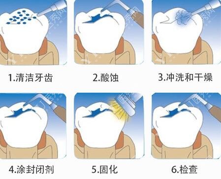 蚌埠牙科收费价目表更新，补牙／修复类项目价格超低！(图1)
