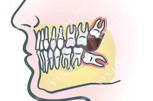 智齿在口腔内的生长图片